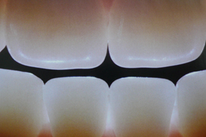 Zahnimplantat als Zahnersatz
